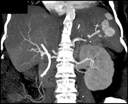 Splenic Hemangiomas - CTisus CT Scan