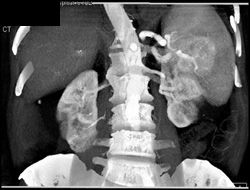 Splenic Hemangiomas - CTisus CT Scan