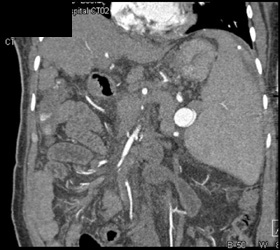 Splenic Artery Aneurysm - CTisus CT Scan