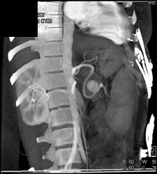 Splenic Artery Aneurysm - CTisus CT Scan