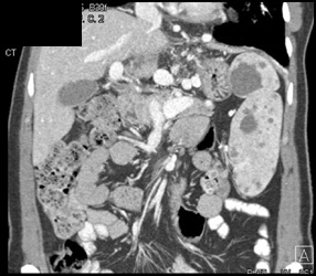 Splenic Hemangiomas - CTisus CT Scan