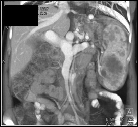 Splenic Hemangiomas - CTisus CT Scan