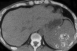 PCP in Lung and Spleen - CTisus CT Scan