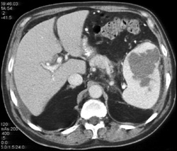 Splenic Abscess - CTisus CT Scan