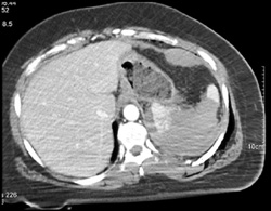 Splenic Infarction S/P Trauma - CTisus CT Scan