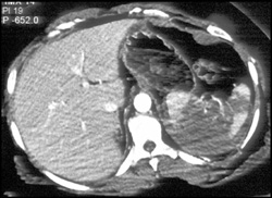 Splenic Infarction and Poor Perfusion - CTisus CT Scan