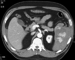 Splenic Laceration - CTisus CT Scan