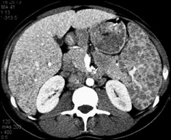 Sarcoidosis - CTisus CT Scan