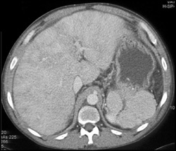 Multiple Splenules - CTisus CT Scan