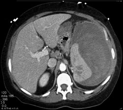 Subcapsular Hematoma Due to Mononucleosis - CTisus CT Scan