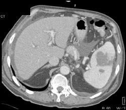 Splenic Abscess - CTisus CT Scan