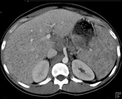 Sarcoidosis - CTisus CT Scan