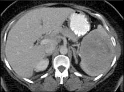 Hamartoma of the Spleen - CTisus CT Scan