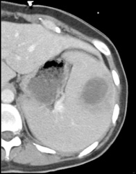 Splenic Abscess - CTisus CT Scan