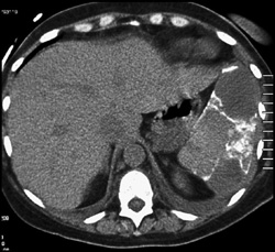 Sickle Cell Disease With Prior Infarct - CTisus CT Scan