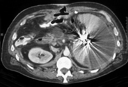 Splenic Infarction S/P Embolization - CTisus CT Scan