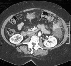 Splenic Abscess - CTisus CT Scan