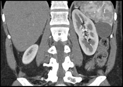 Splenic Cyst - CTisus CT Scan