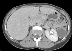 Splenic Cyst - CTisus CT Scan