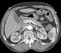 Splenic Cyst - CTisus CT Scan