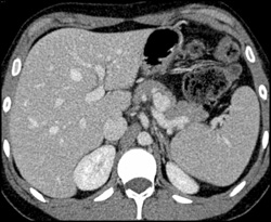 Splenic Artery Aneurysm - CTisus CT Scan