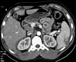 Splenic Laceration S/P Trauma - CTisus CT Scan