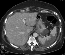 Splenic Infarction - CTisus CT Scan