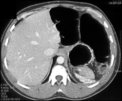 Small Dense Spleen in Sickle Cell Disease - CTisus CT Scan