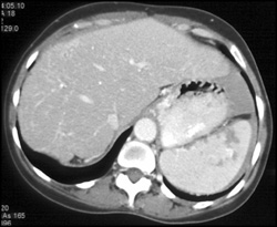 Splenic Infarcts - CTisus CT Scan