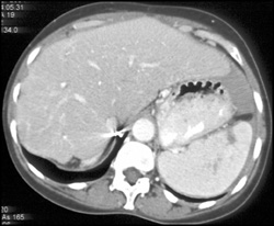 Splenic Infarcts - CTisus CT Scan