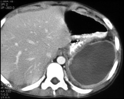 Subcapsular and Intrasplenic Bleed - CTisus CT Scan