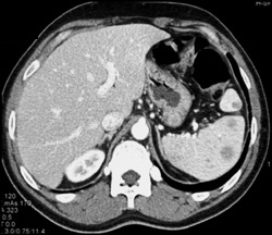 Lymphoma - CTisus CT Scan