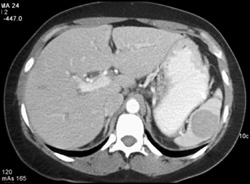 Splenic Cyst - CTisus CT Scan