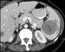 Splenic Lymphoma - CTisus CT Scan