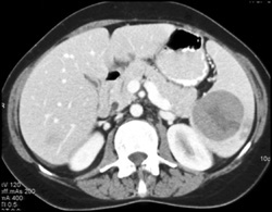 Splenic Lymphoma - CTisus CT Scan