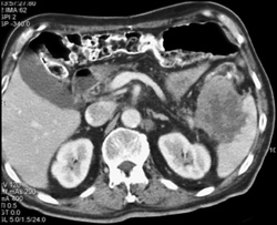 Splenic Lymphoma - CTisus CT Scan