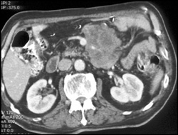 Splenic Lymphoma - CTisus CT Scan