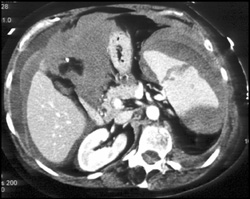 Splenic Laceration With Subcapsular Blood - CTisus CT Scan