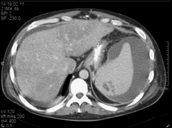 Splenic Laceration - CTisus CT Scan