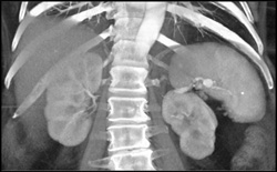 Splenic Artery Aneurysm - CTisus CT Scan