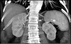 Splenic Artery Aneurysm - CTisus CT Scan