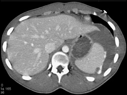 Splenic Trauma With Active Extravasation - CTisus CT Scan