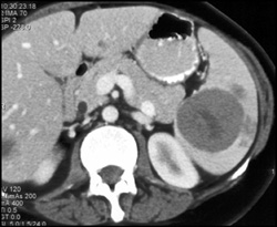 Splenic Lymphoma - CTisus CT Scan