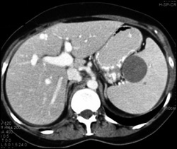 Splenic Lymphoma - CTisus CT Scan