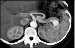 Splenic Artery Aneurysm - CTisus CT Scan