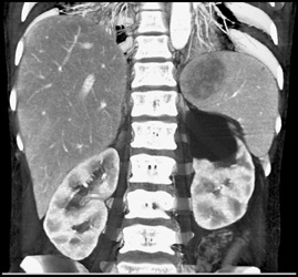 Splenic Lymphoma - CTisus CT Scan