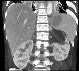 Splenic Lymphoma - CTisus CT Scan