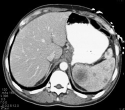 Splenic Lymphoma - CTisus CT Scan