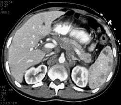 Splenic Lymphoma - CTisus CT Scan