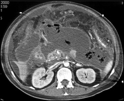 Pancreatic Abscess Extends to Perisplenic Space - CTisus CT Scan